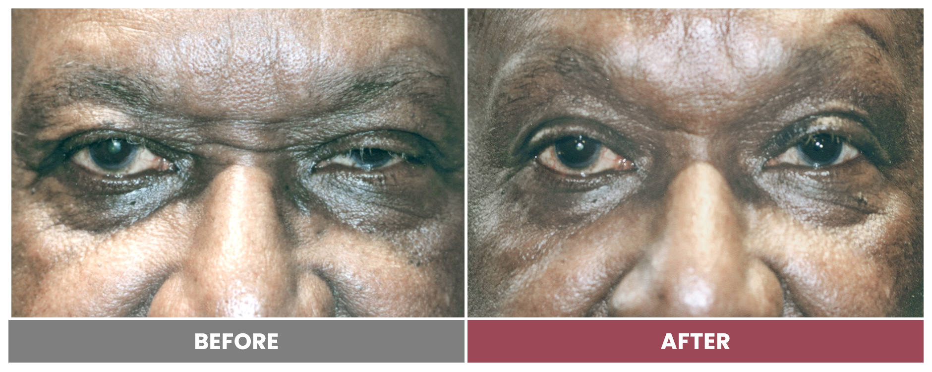 PTOSIS REPAIR - Case 52